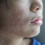 what is melasma