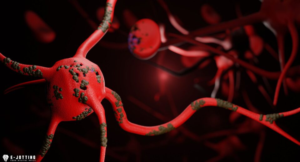 How does diabetes cause neuropathy