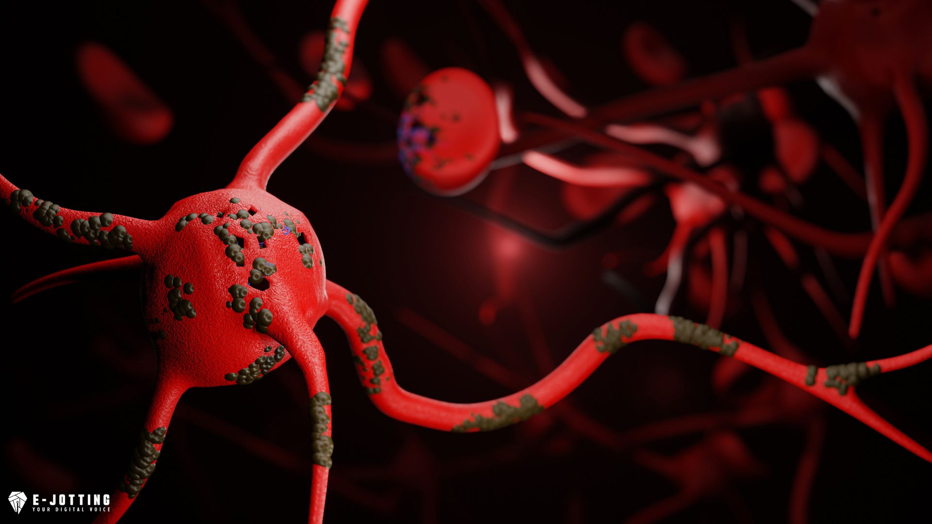 How does diabetes cause neuropathy